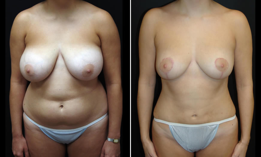 Before & After Liposuction Front View