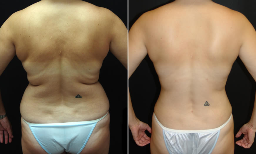 Before & After Liposuction Back View