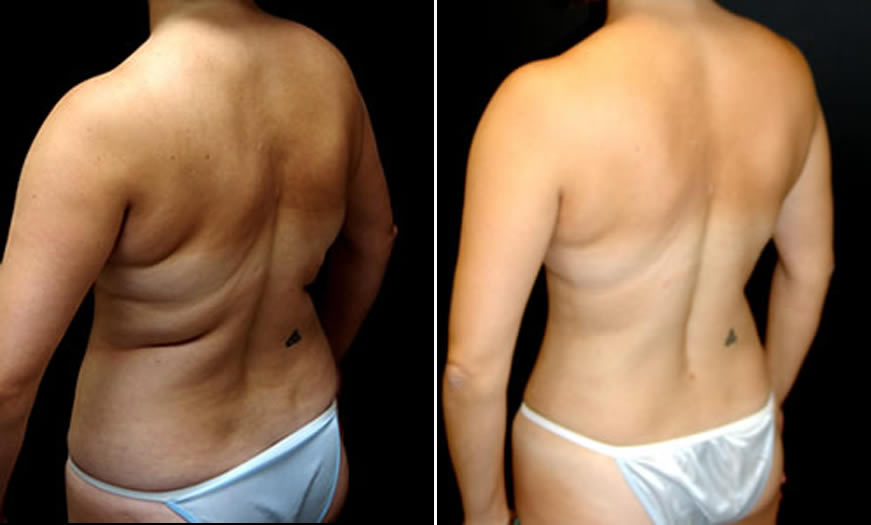 Before & After Liposuction Quarter Back Left View