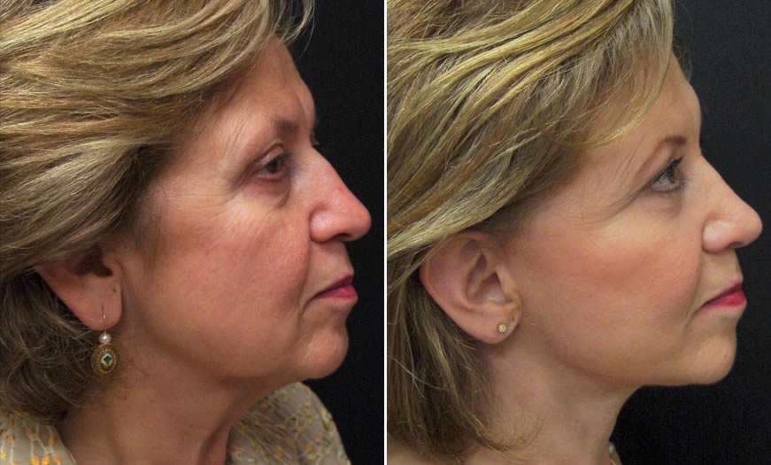 Before & After Earlobe Reduction Side Right View