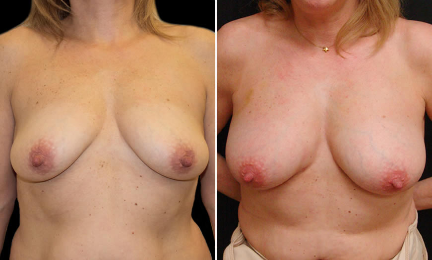 Before & After Fat Grafting Front View