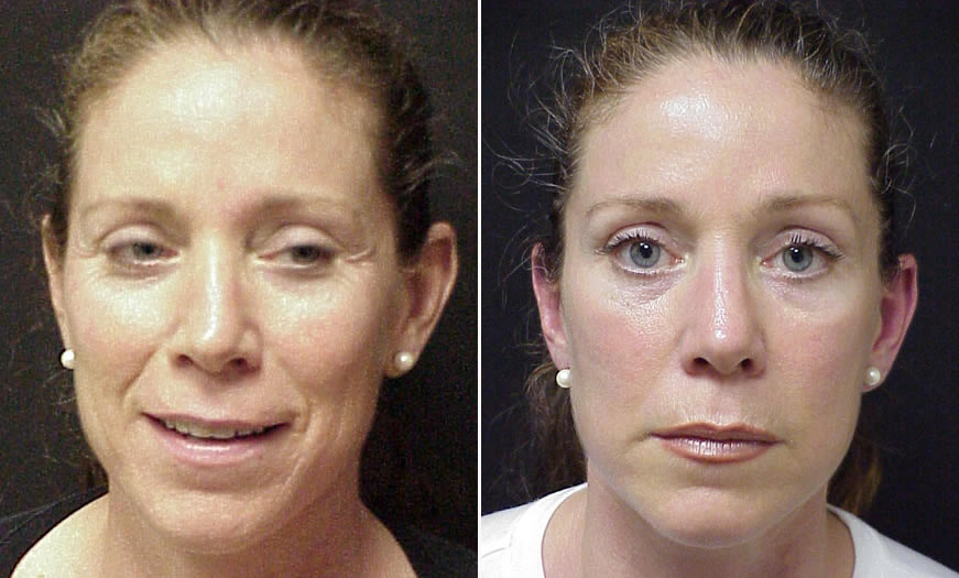 Before & After BOTOX Cosmetic Front View