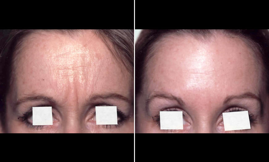 Before & After BOTOX Cosmetic Front View