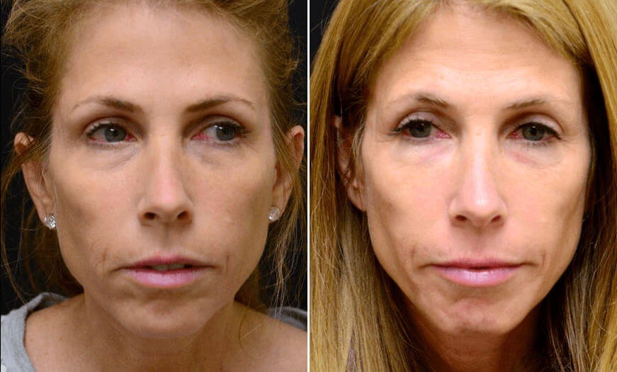 Before & After Cosmetic Fillers Front View