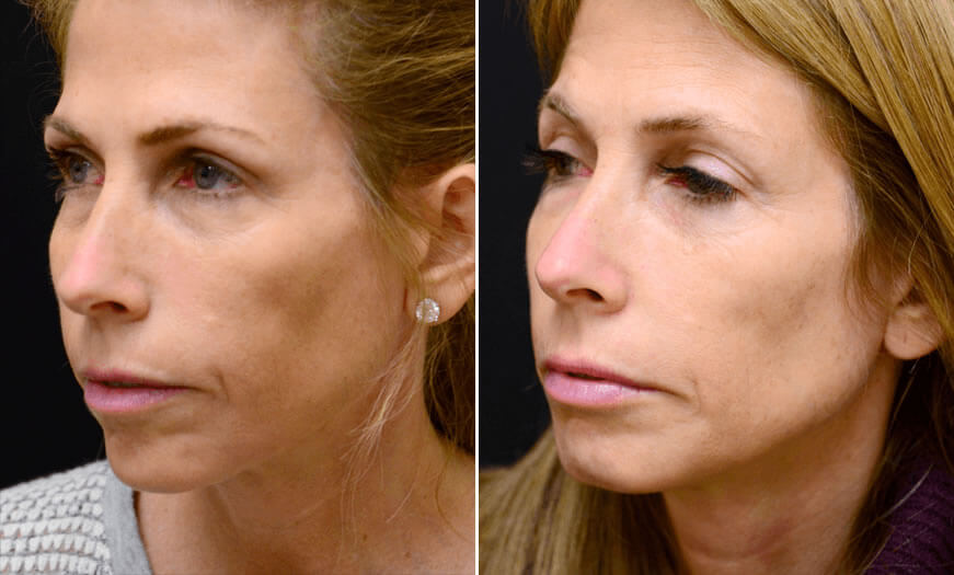 Before & After Cosmetic Fillers Quarter Left View