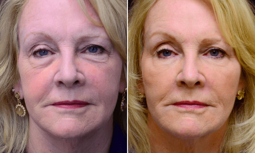 Before & After Cosmetic Fillers Front View 1