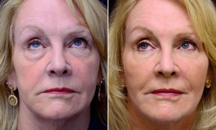 Before & After Cosmetic Fillers Front View 2