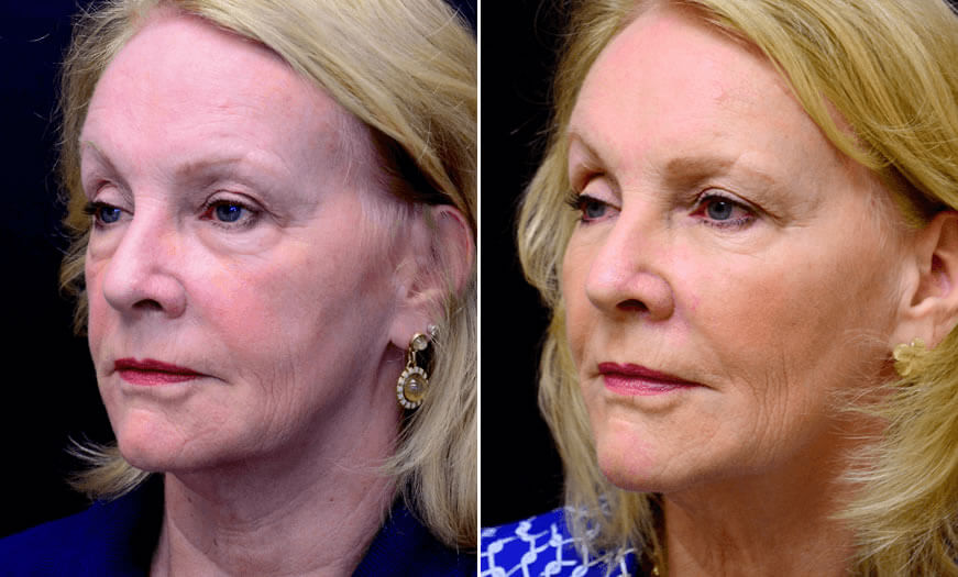 Before & After Cosmetic Fillers Quarter Left View