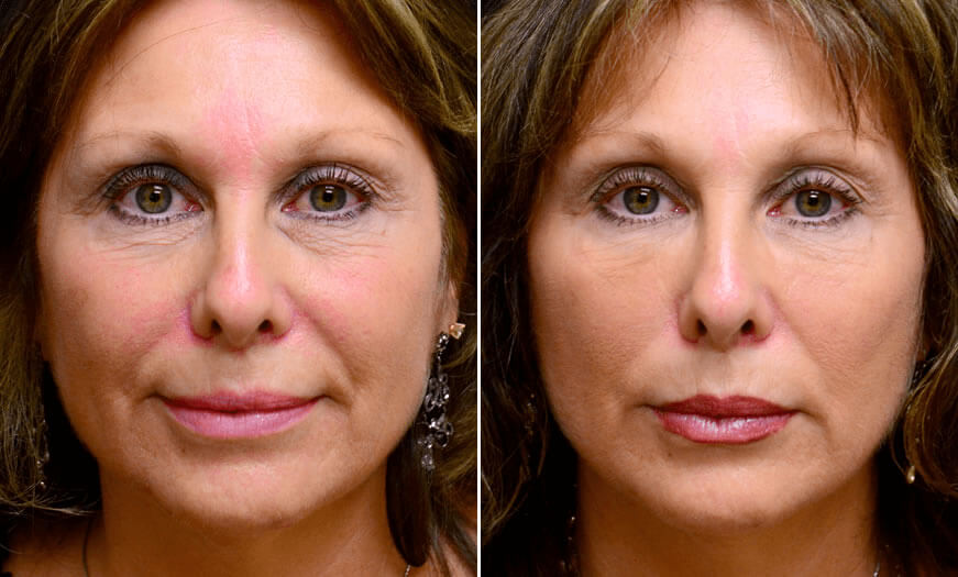 Before & After Cosmetic Fillers Front View 1