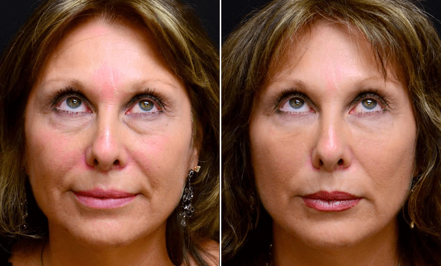 Before & After Cosmetic Fillers Front View 2