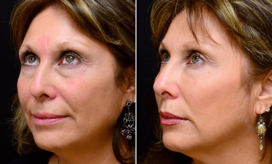 Before & After Cosmetic Fillers Quarter Left View