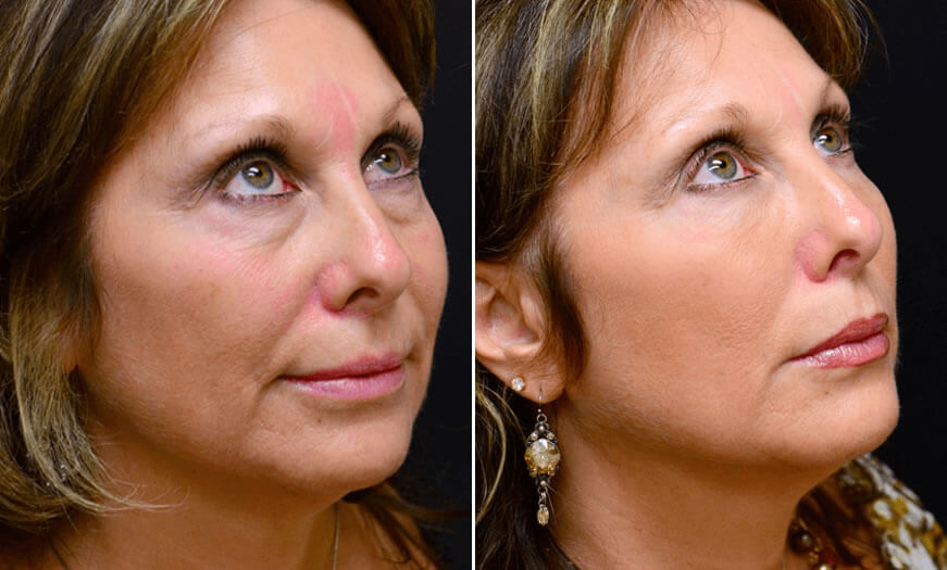 Before & After Cosmetic Fillers Quarter Right View