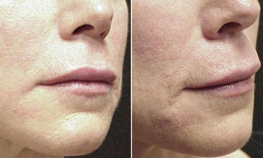 Before & After Cosmetic Fillers Quarter Right View