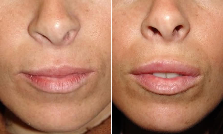 Before & After Cosmetic Fillers Front View