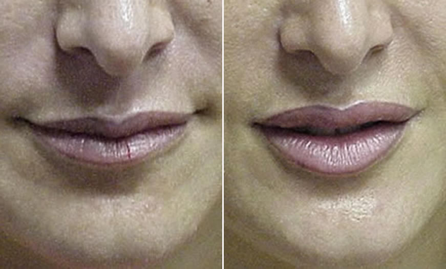 Before & After Cosmetic Fillers Front View