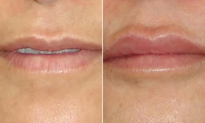 Before & After Cosmetic Fillers Front View