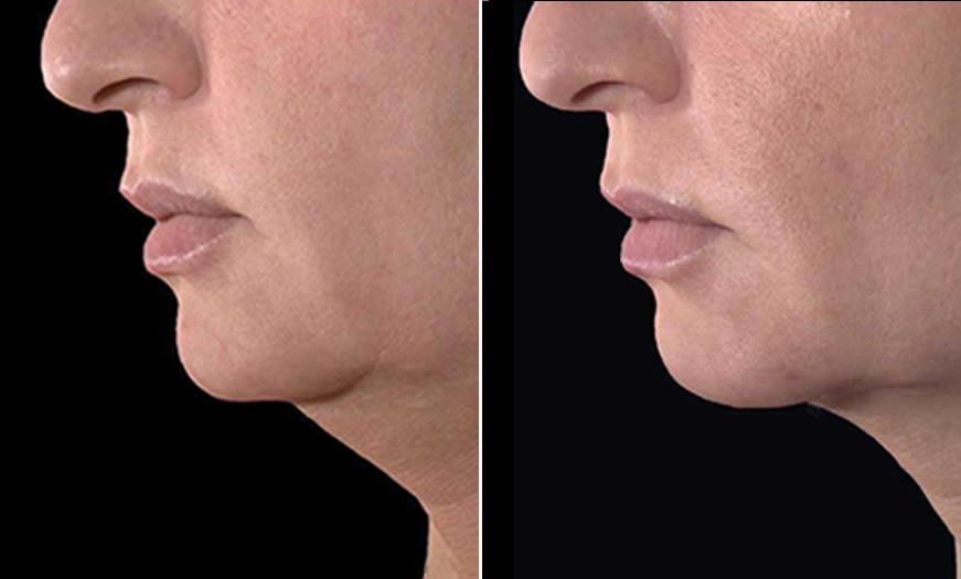 Before & After Ultherapy Side Left View
