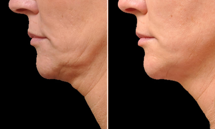 Before & After Ultherapy Side Left View