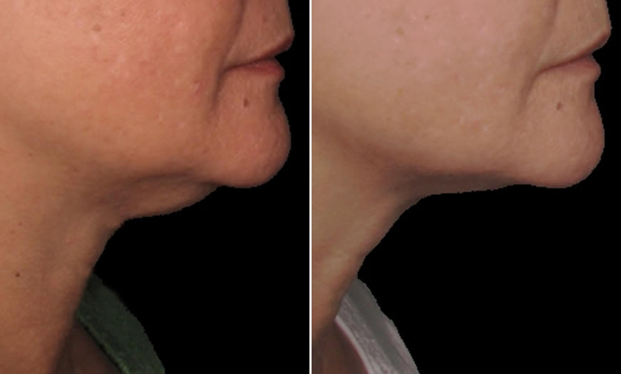 Before & After Ultherapy Side Right View