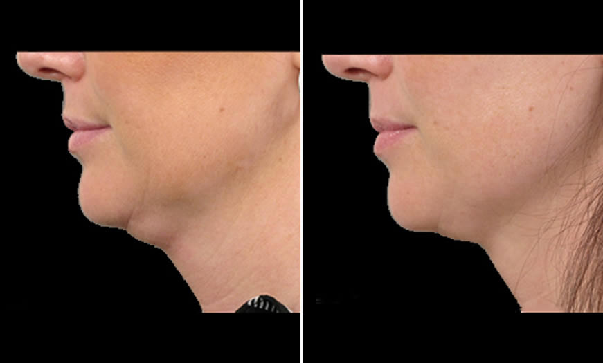 Before & After Ultherapy Side Left View