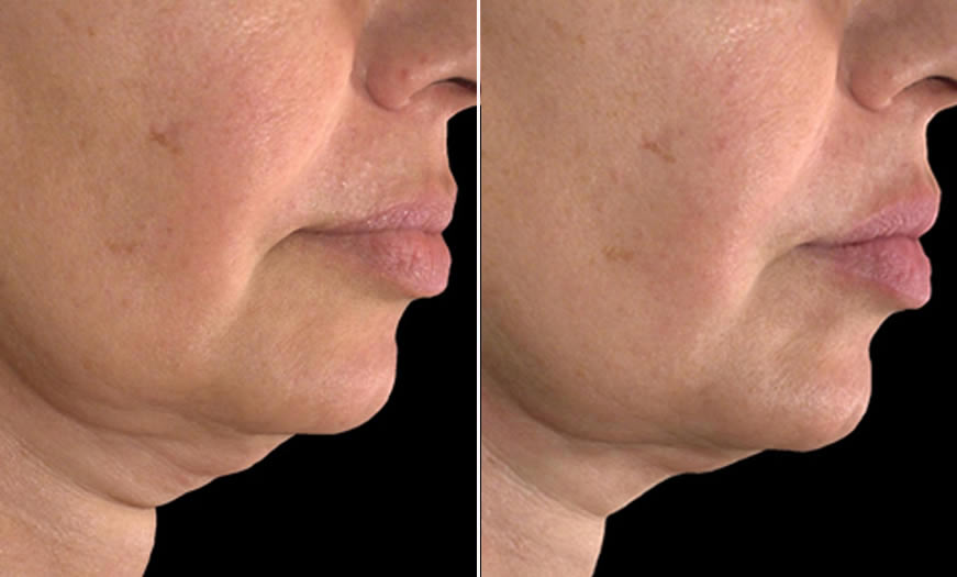 Before & After Ultherapy Side Right View