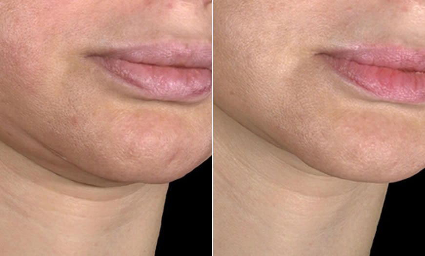 before & after Ultherapy Quarter Right View