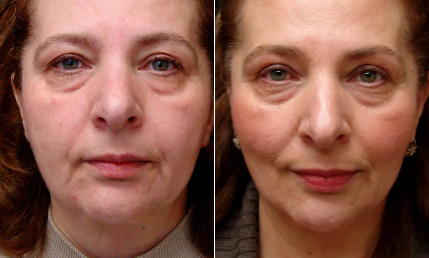 Before & After Ultherapy Front View