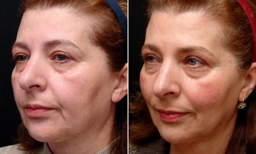 Before & After Ultherapy Quarter Left View