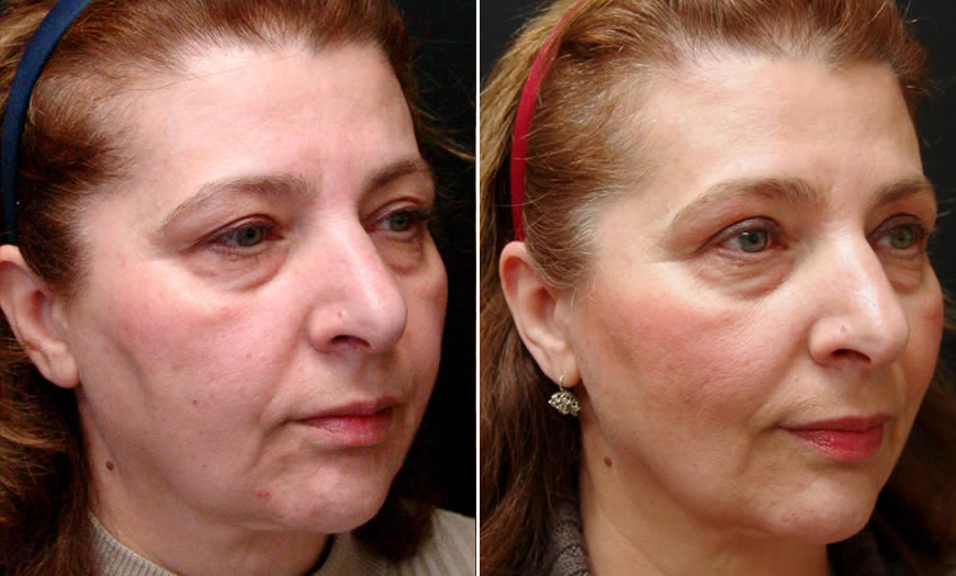 before & after Ultherapy Quarter Right View