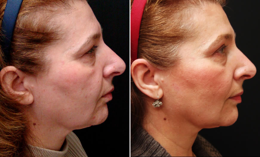 Before & After Ultherapy Side Right View
