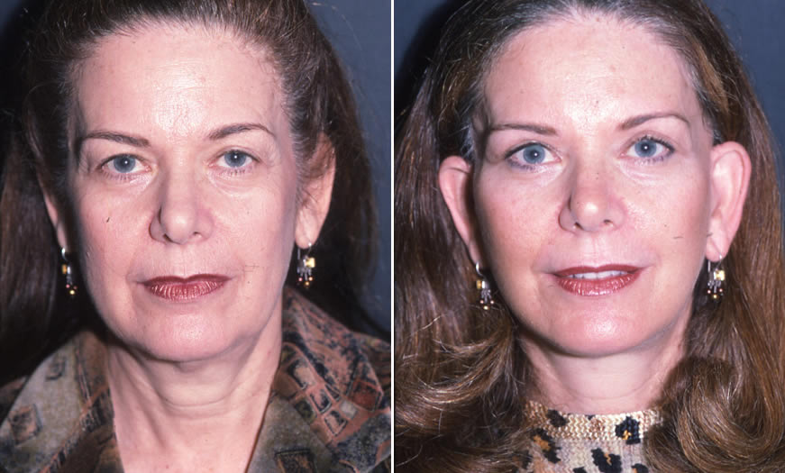 Before & After Combination Procedures Front View