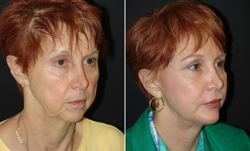 Before & After Combination Procedures Quarter Right View