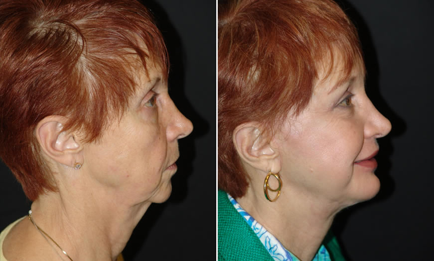 Before & After Combination Procedures Side Right View