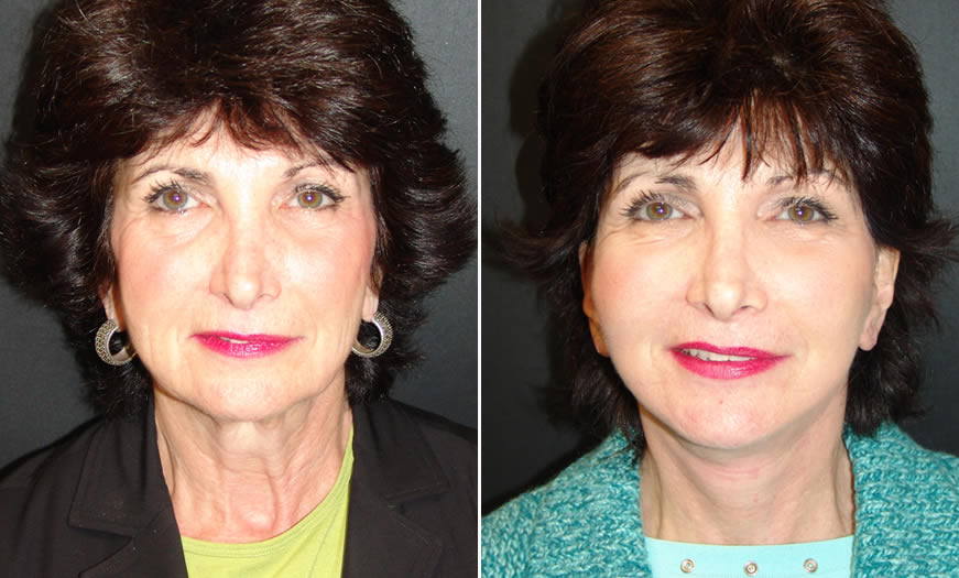 Before & After Combination Procedures Front View