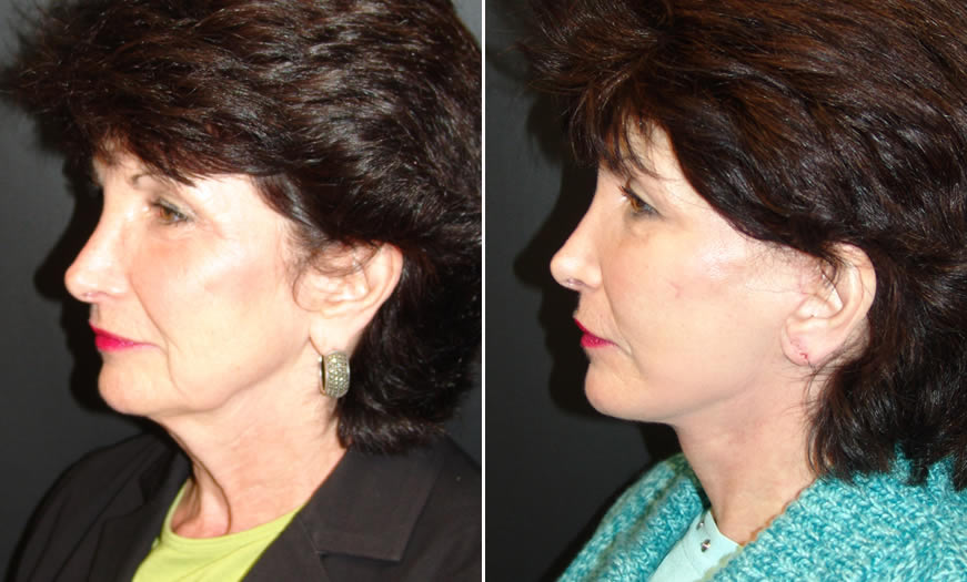 Before & After Combination Procedures Side Left View