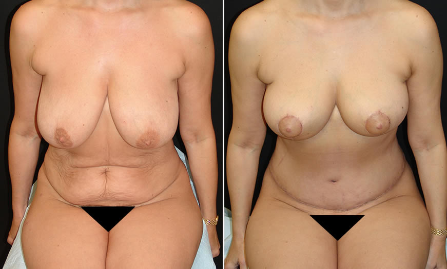 Before & After Combination Procedures Front View