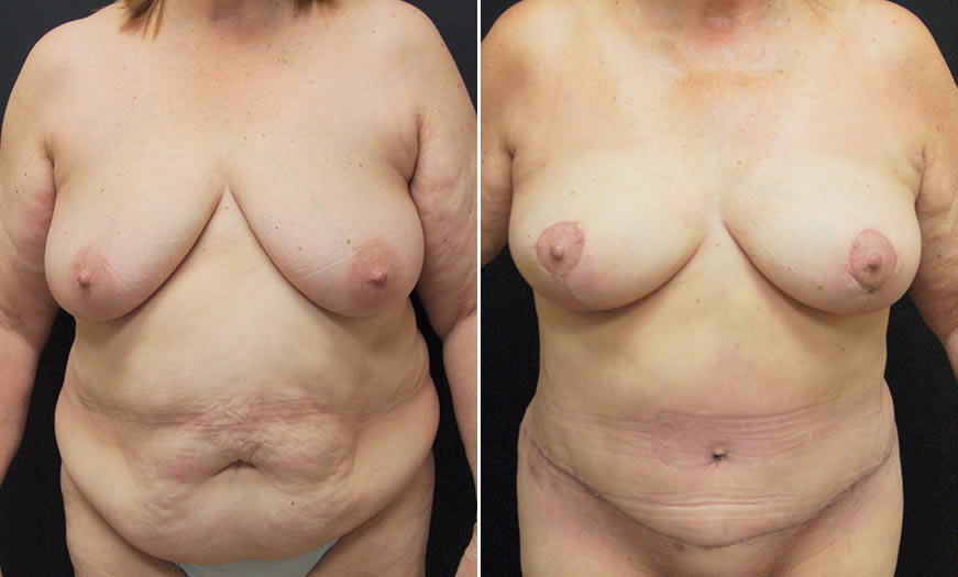 Before & After Combination Procedures Front View