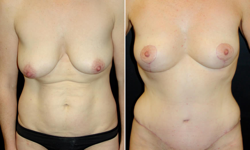 Before & After Combination Procedures Front View