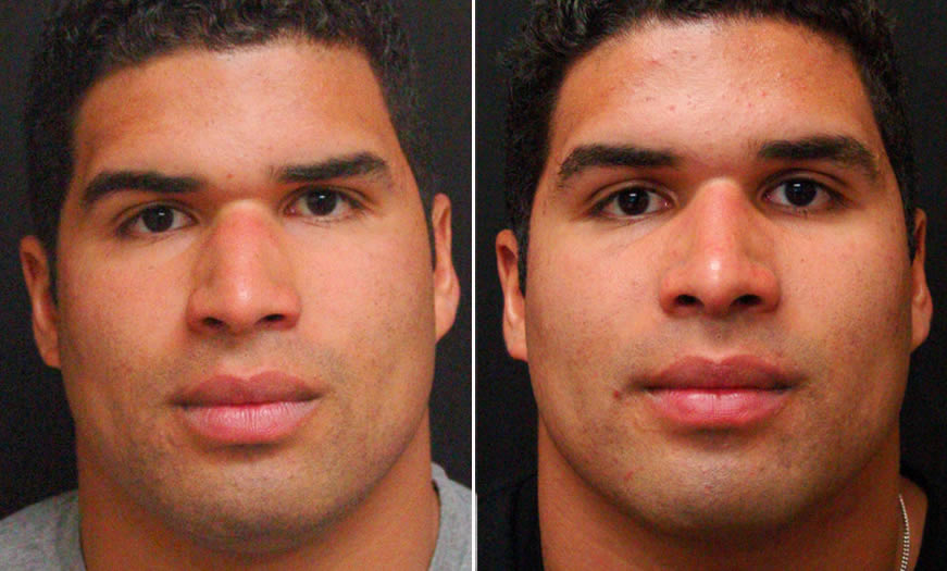 Before & After Rhinoplasty Front View