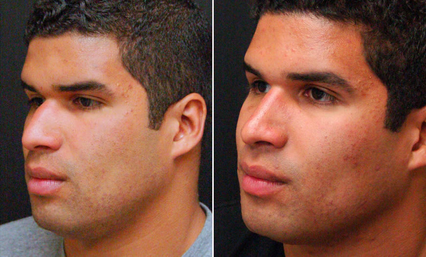 Before & After Rhinoplasty Quarter Left View