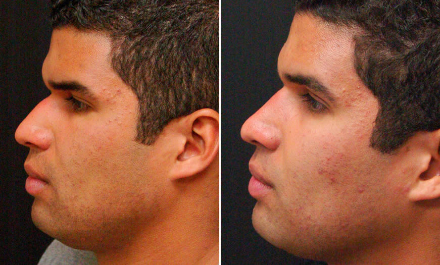 Before & After Rhinoplasty Side Left View