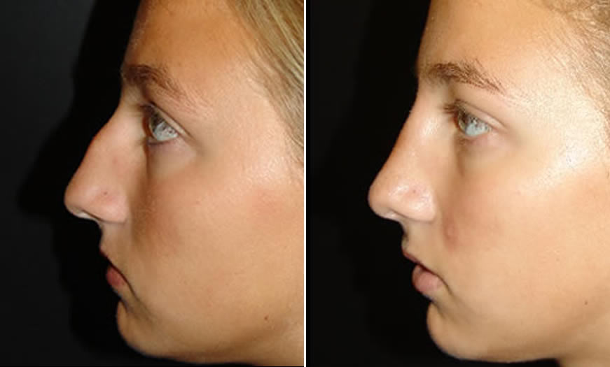 Before & After Rhinoplasty Side Left View