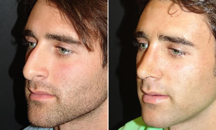 Before & After Rhinoplasty Quarter Left View