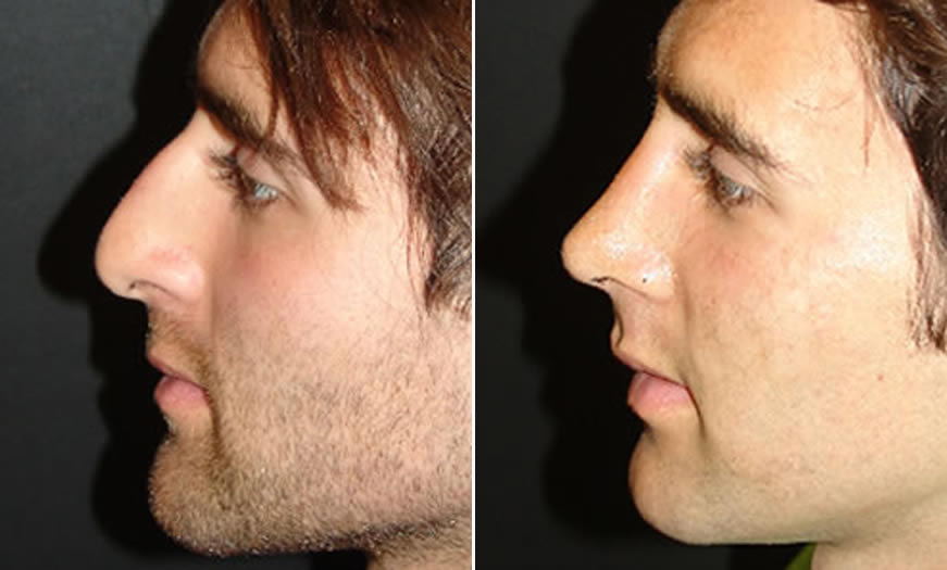 Before & After Rhinoplasty Side Left View