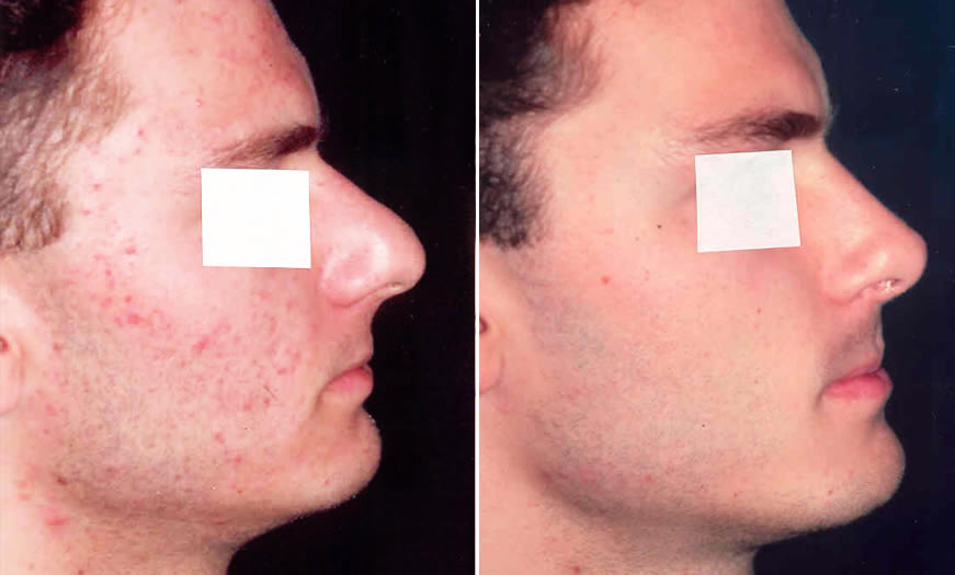 Before & After Rhinoplasty Side Right View