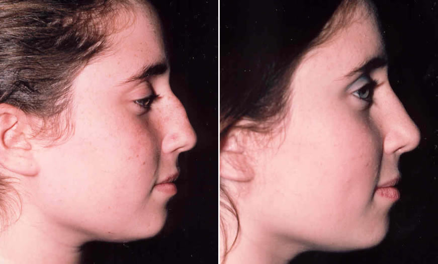 Before & After Rhinoplasty Side Right View