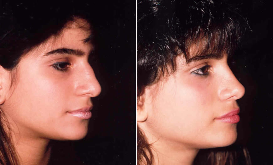 Before & After Rhinoplasty Side Right View