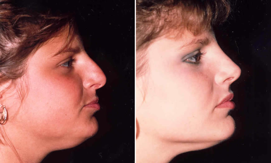 Before & After Rhinoplasty Side Right View