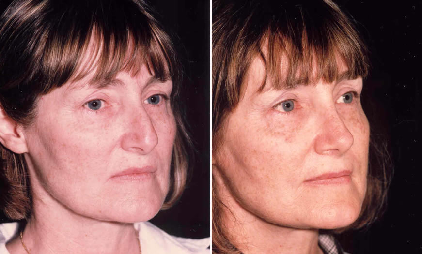 Before & After Rhinoplasty Quarter Right View