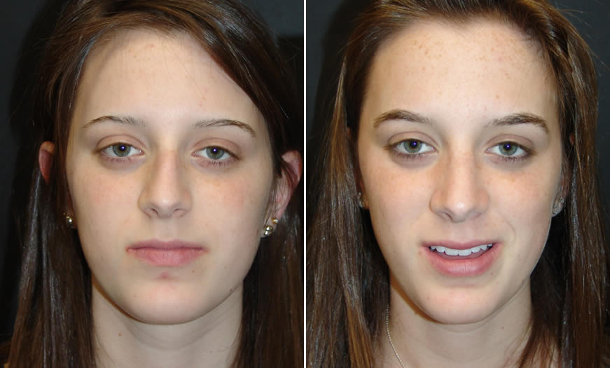 Before & After Rhinoplasty Front View